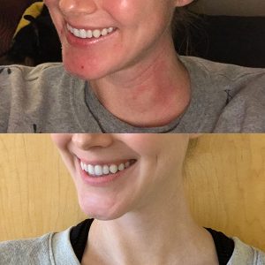 KORA Before and After with Eczema